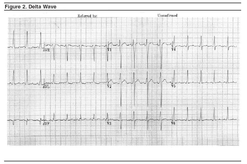 Electrocardiogram